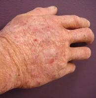 atopic dermatitis project thumbnail