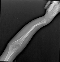 Fractured Bone project thumbnail