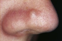 acnes_v12 project thumbnail