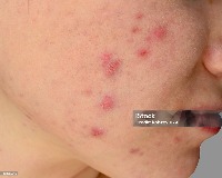 acne_face project thumbnail