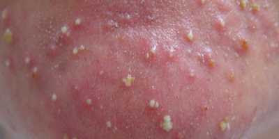 Pustula kaggle Object Detection Dataset by Acne label