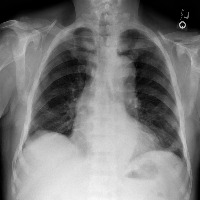 Pleural Effusion Chest X-Ray project thumbnail