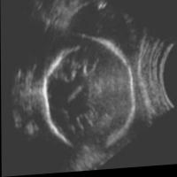fetel head segmentation project thumbnail