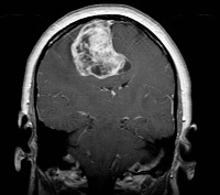 Medical Imaging for Brain tumor project thumbnail