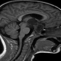 brain detection project thumbnail
