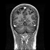 brain detection project thumbnail