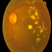 Diabetic Retenopathy project thumbnail