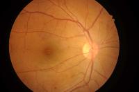 Diabetic Retinopathy project thumbnail