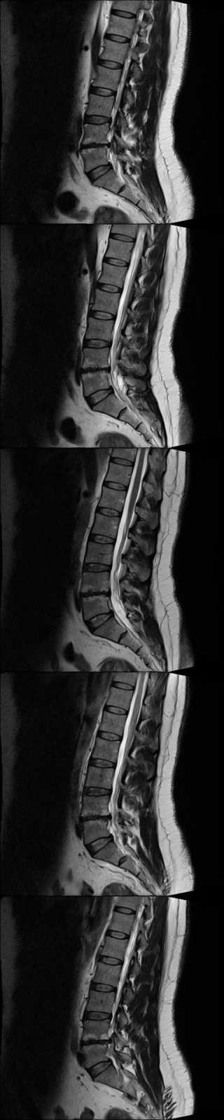 Spinal Stacking Spine MRI 2 - Sagittal Stacking Classification Model by Dans Workspace