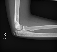 supracondylar detection project thumbnail