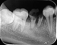 periodontitis project thumbnail