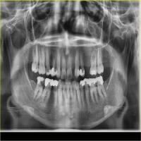 missing teeth project thumbnail