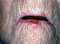 oral-cancer-dataset project thumbnail