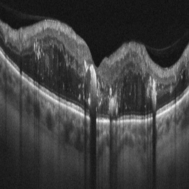prue_oct_test Instance Segmentation Model by pruetest