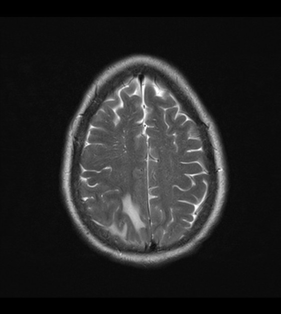mri of brain tumor