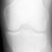 Knee Osteoarthritis project thumbnail