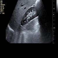 Kidney stone project thumbnail