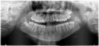 dental-diseases project thumbnail