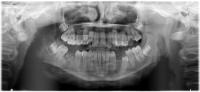 periapical_aug project thumbnail