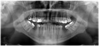 dental-diseases project thumbnail