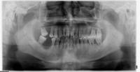Normal bone loss project thumbnail