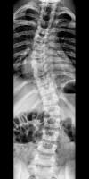 scoliosis project thumbnail