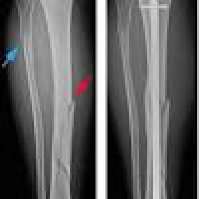 Bone Break Classification - Roboflow Universe
