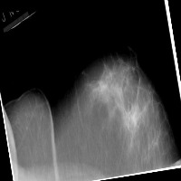 breastcancerdetect project thumbnail