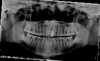 Wisdom teeth project thumbnail