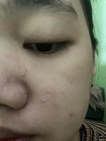 Find acnes, faces and skins project thumbnail