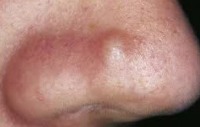 acne detection project thumbnail