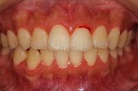 Periodontitis Detection project thumbnail
