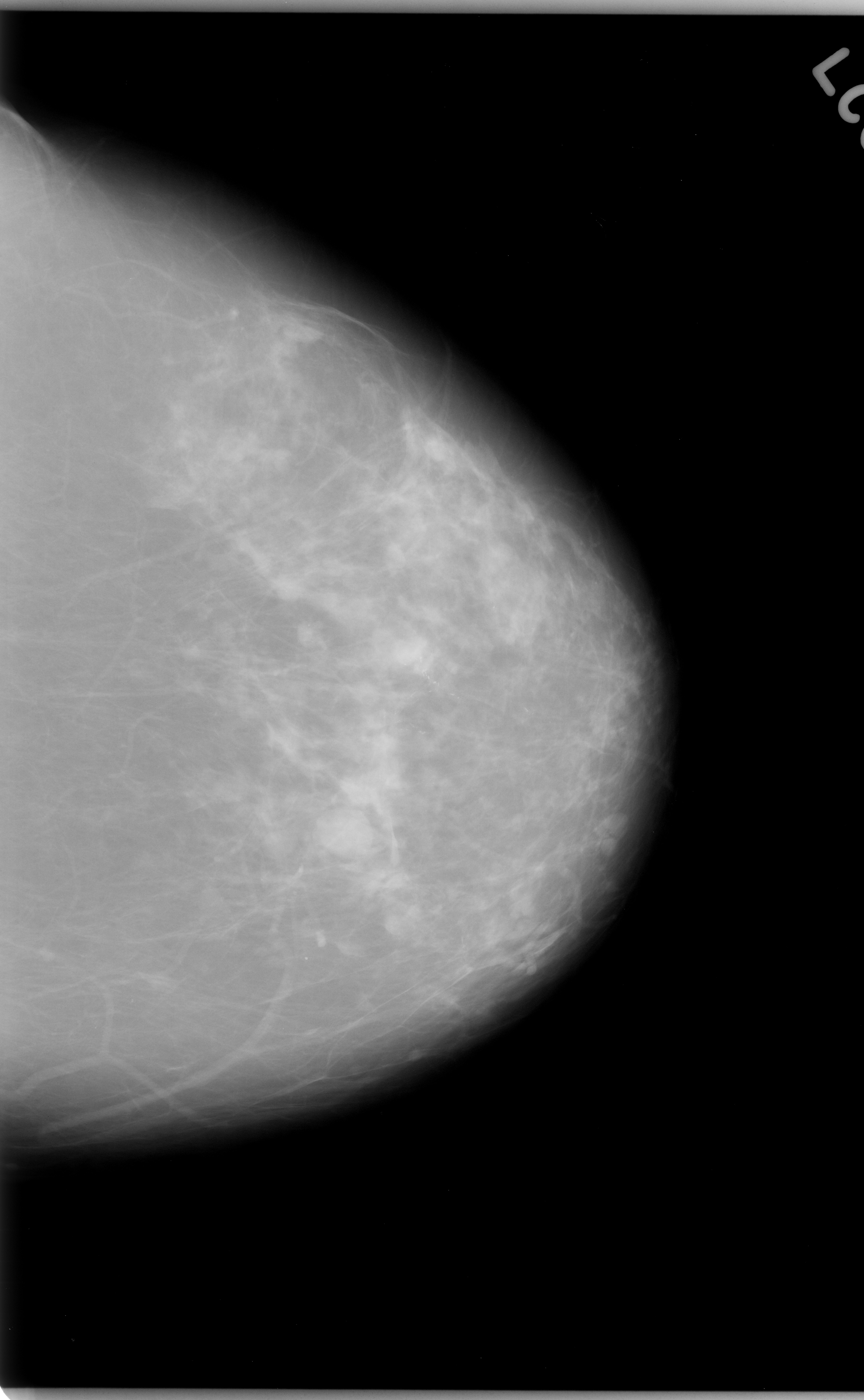 BreastCancer-YOLOv8 Object Detection Dataset by Test1