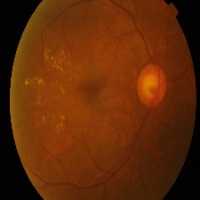 diabetic retinopathy project thumbnail