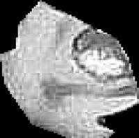 Brain Tumor project thumbnail
