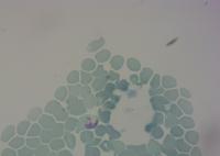 Malaria project thumbnail