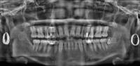 FDI-TOOTH_ENUMERATION project thumbnail