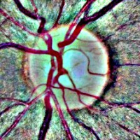 glaucoma retinopathy project thumbnail