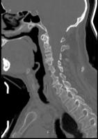 Odontoid Fraktür-Original(Test) project thumbnail