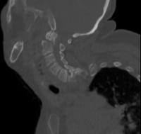 Odontoid Fraktür-Original project thumbnail