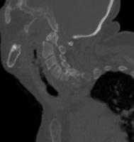 Odontoid Fraktür-Anotasyon project thumbnail
