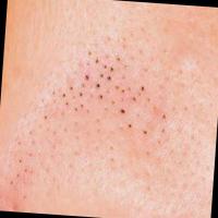 Acne Type Detection project thumbnail