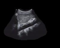 liver deteksi project thumbnail