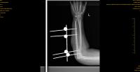 Fracture-elbow-detection project thumbnail