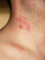 skin-disease project thumbnail