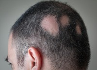 Alopecia Areata2 project thumbnail