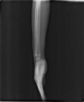 Hairline Fracture Detection  project thumbnail
