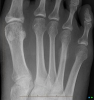 Hairline Fracture Detection project thumbnail