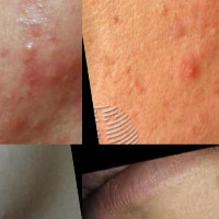 blackheadsDetects project thumbnail