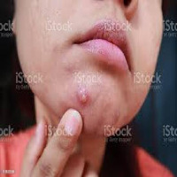skin problems detect Object Detection Dataset by umm alqura